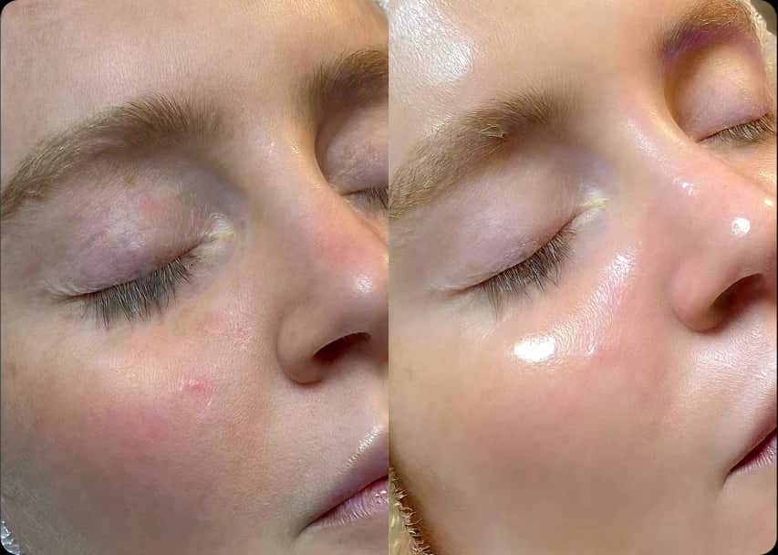 HydraFacial Glow at Rani Beauty Clinic