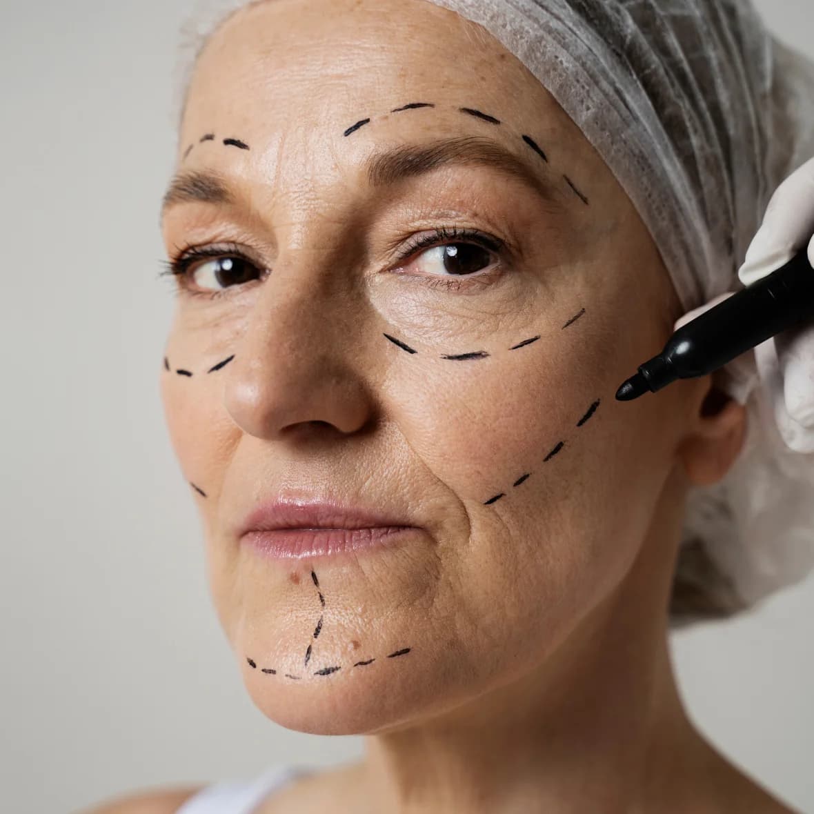 HydraFacial treatment 1
