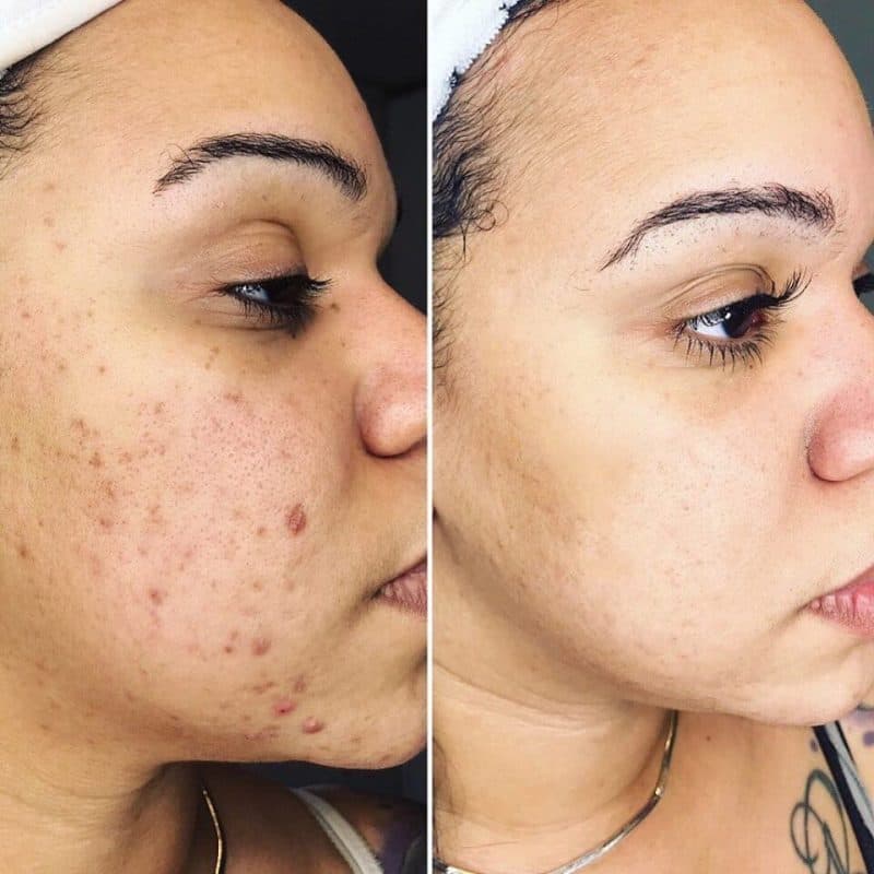 Scar Reduction treatment at Rani Beauty Clinic Renton