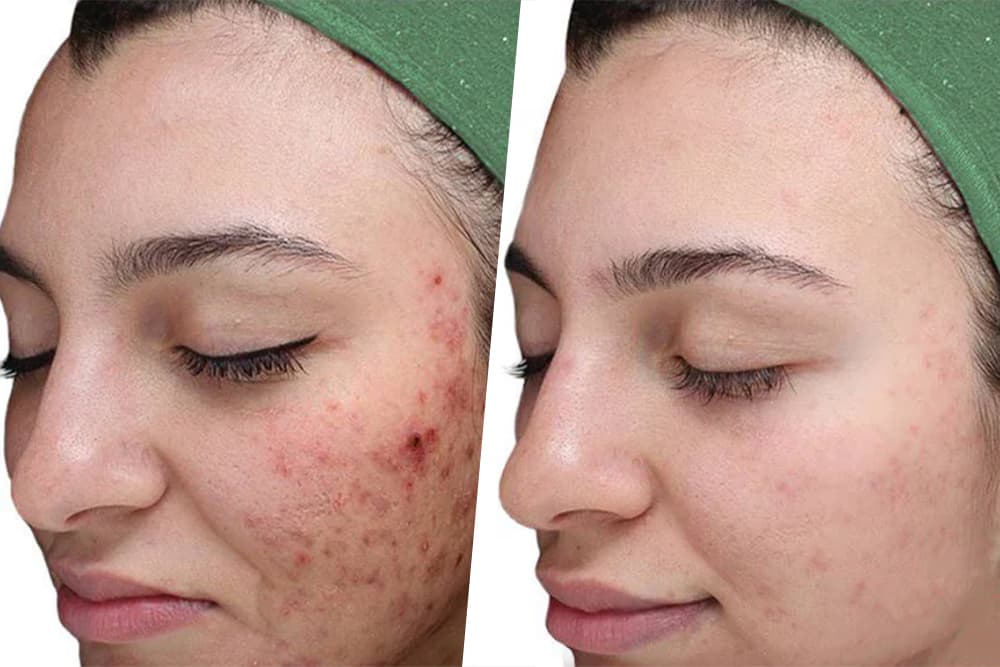 Chemical Peels Before & After result 3 at Rani Beauty Clinic