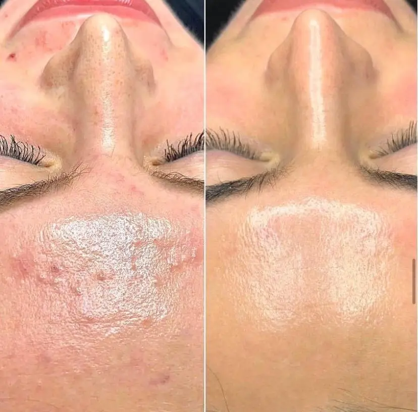 BioRePeel treatment at Rani Beauty Clinic Renton