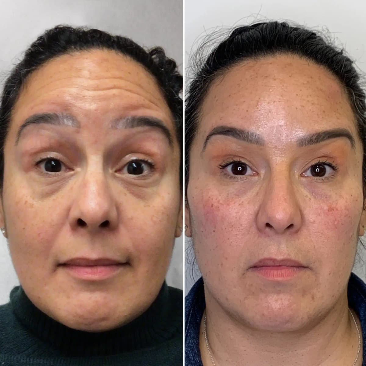 Botox & Dysport Before & After result 2