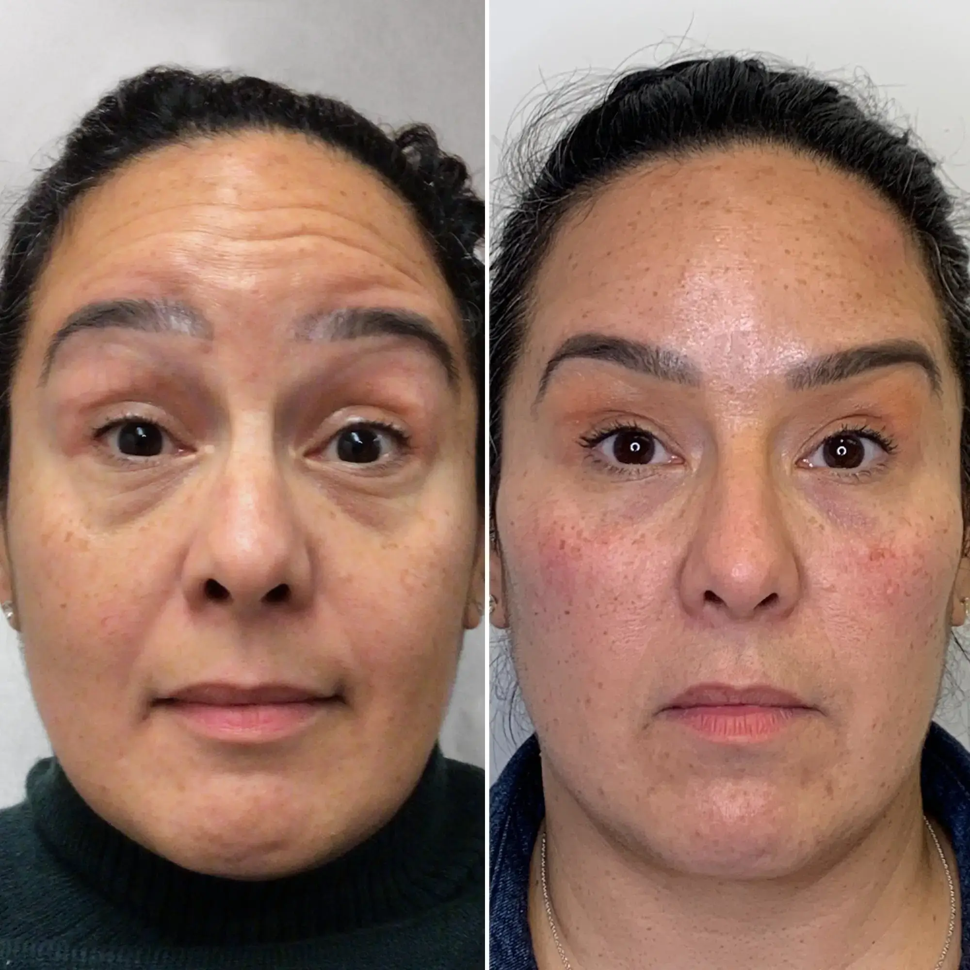 Botox & Dysport Before & After result 2 at Rani Beauty Clinic