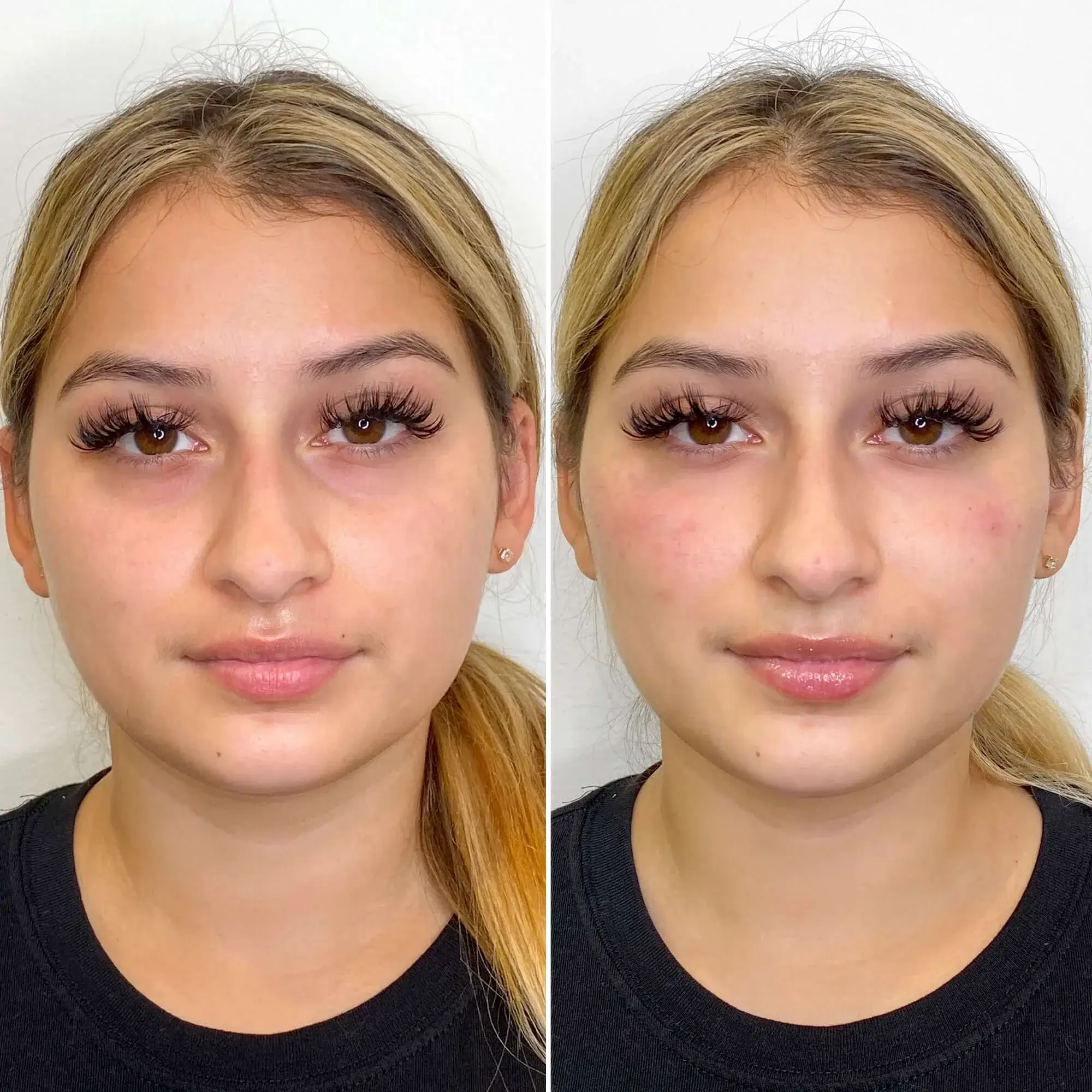 Dermal Fillers Before & After result 4 at Rani Beauty Clinic