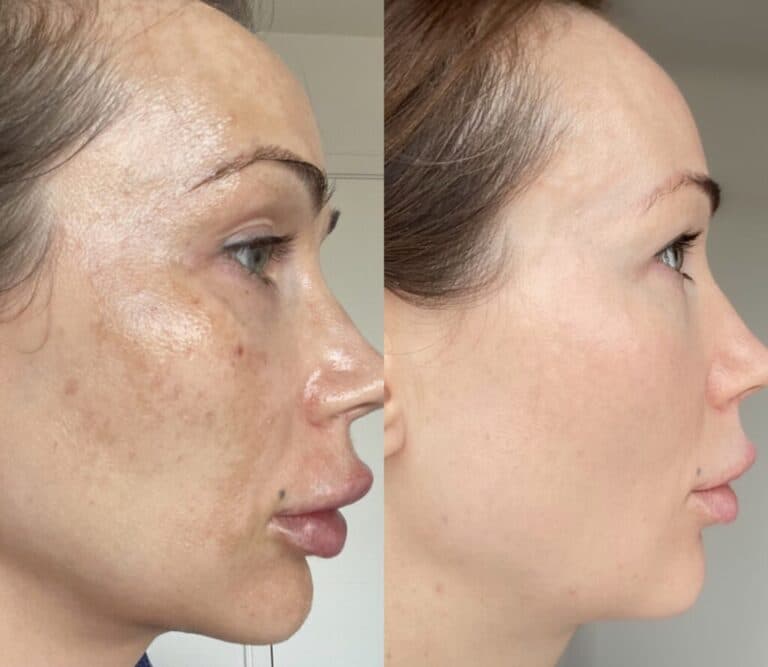 Cosmelan Peel treatment at Rani Beauty Clinic Renton