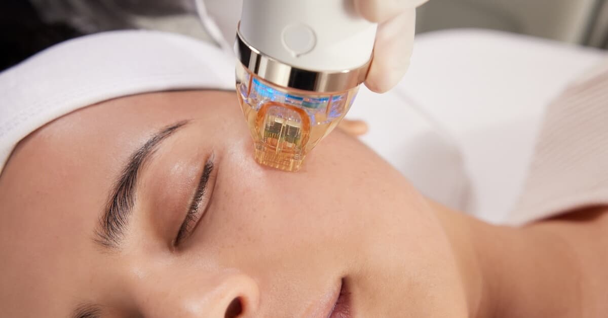 RF Microneedling Before & After