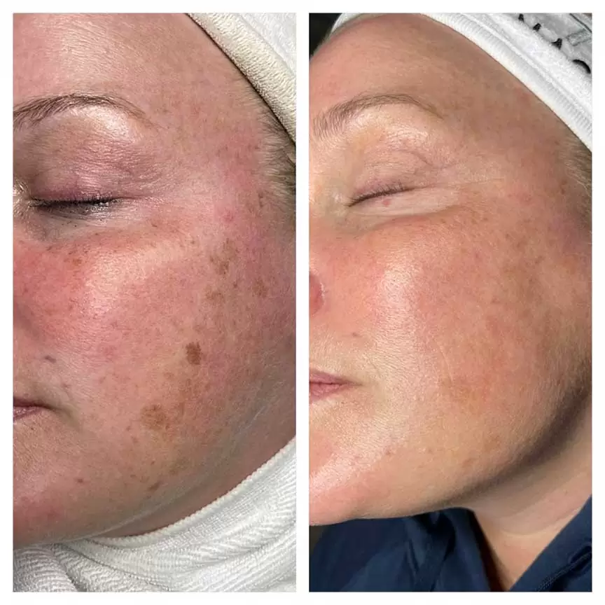 RF Microneedling Before & After result 2 at Rani Beauty Clinic