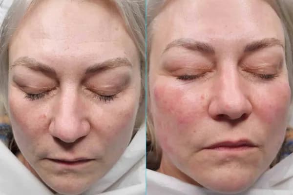 HydraFacial treatment 6