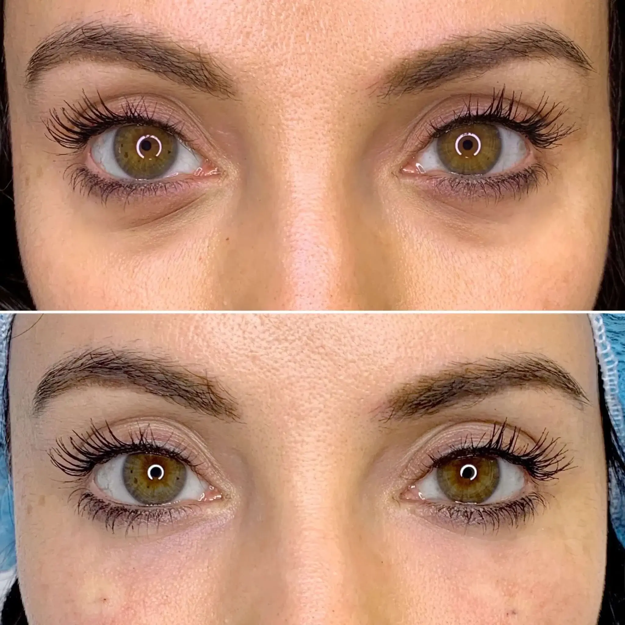 Microneedling w/ Arrissence — Undereyes treatment at Rani Beauty Clinic Renton