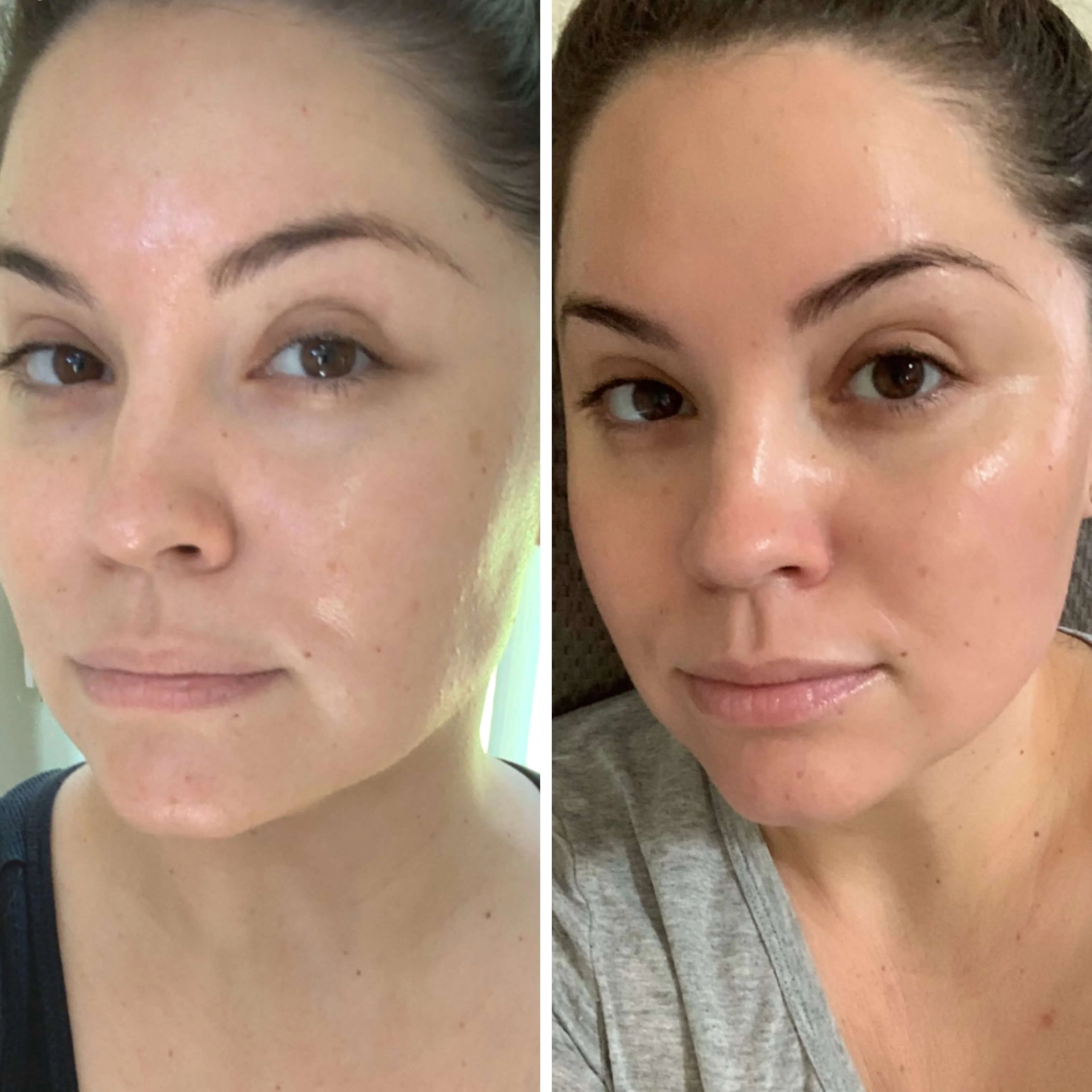 RF Microneedling Before & After result 6 at Rani Beauty Clinic