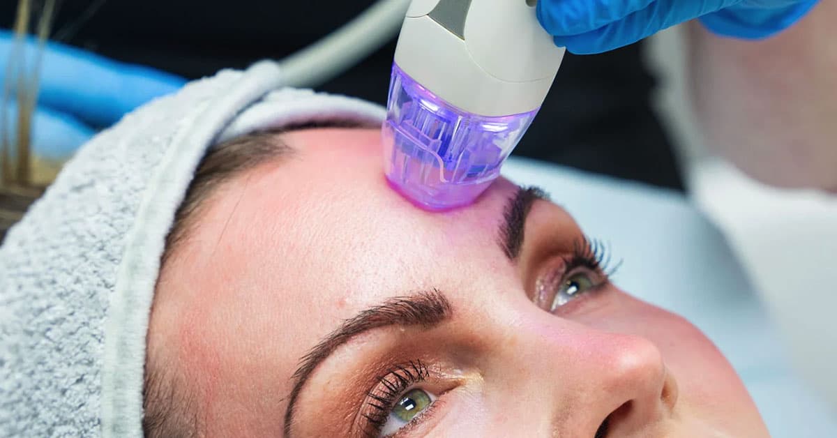 RF Microneedling treatment at Rani Beauty Clinic Renton