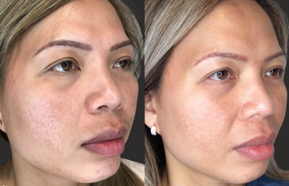 RF Microneedling Before & After result 4
