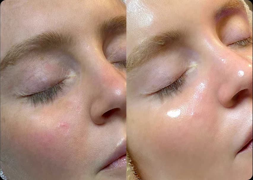 HydraFacial Before & After result 2 at Rani Beauty Clinic
