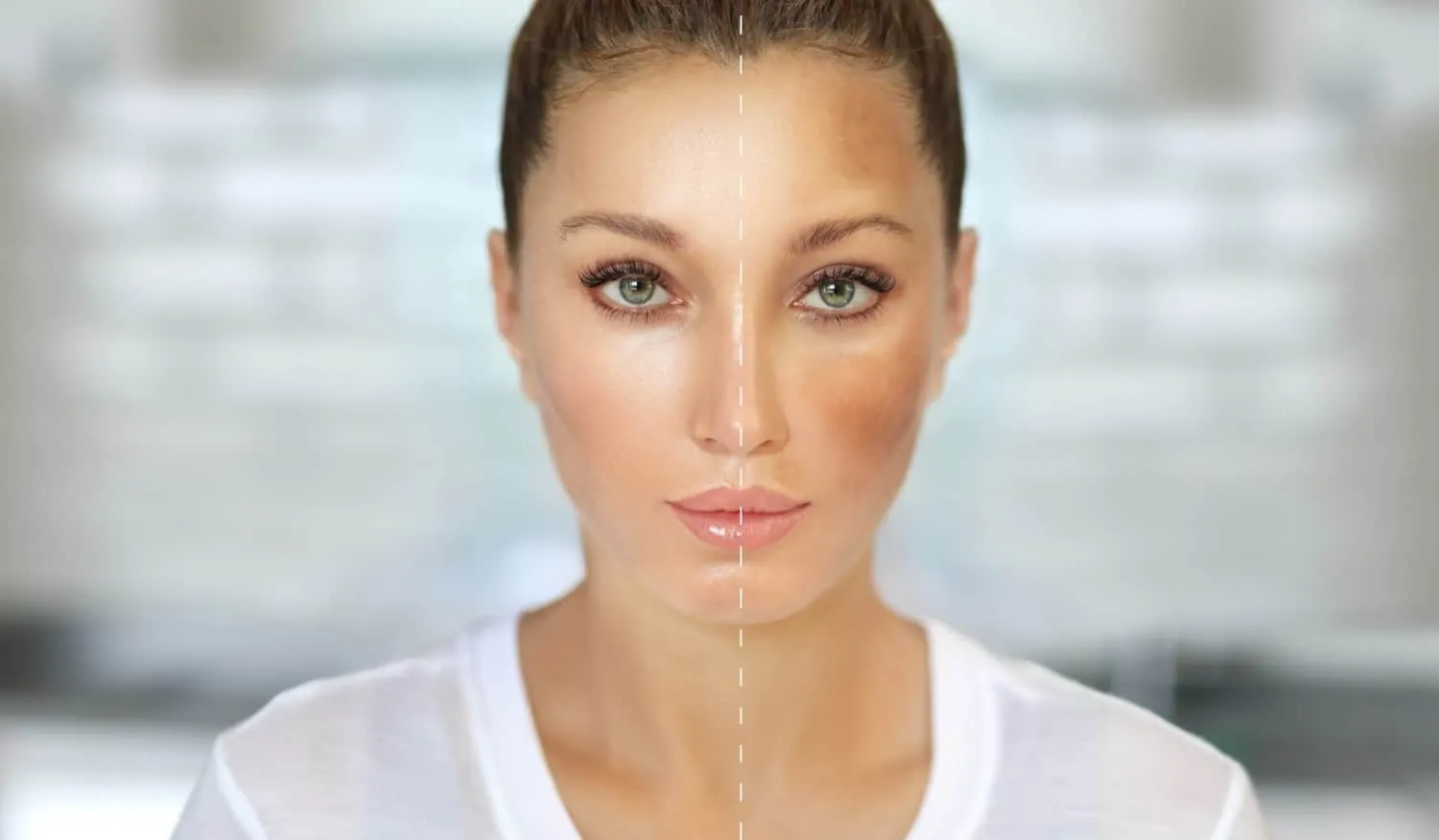 Chemical Peels Before & After result 5