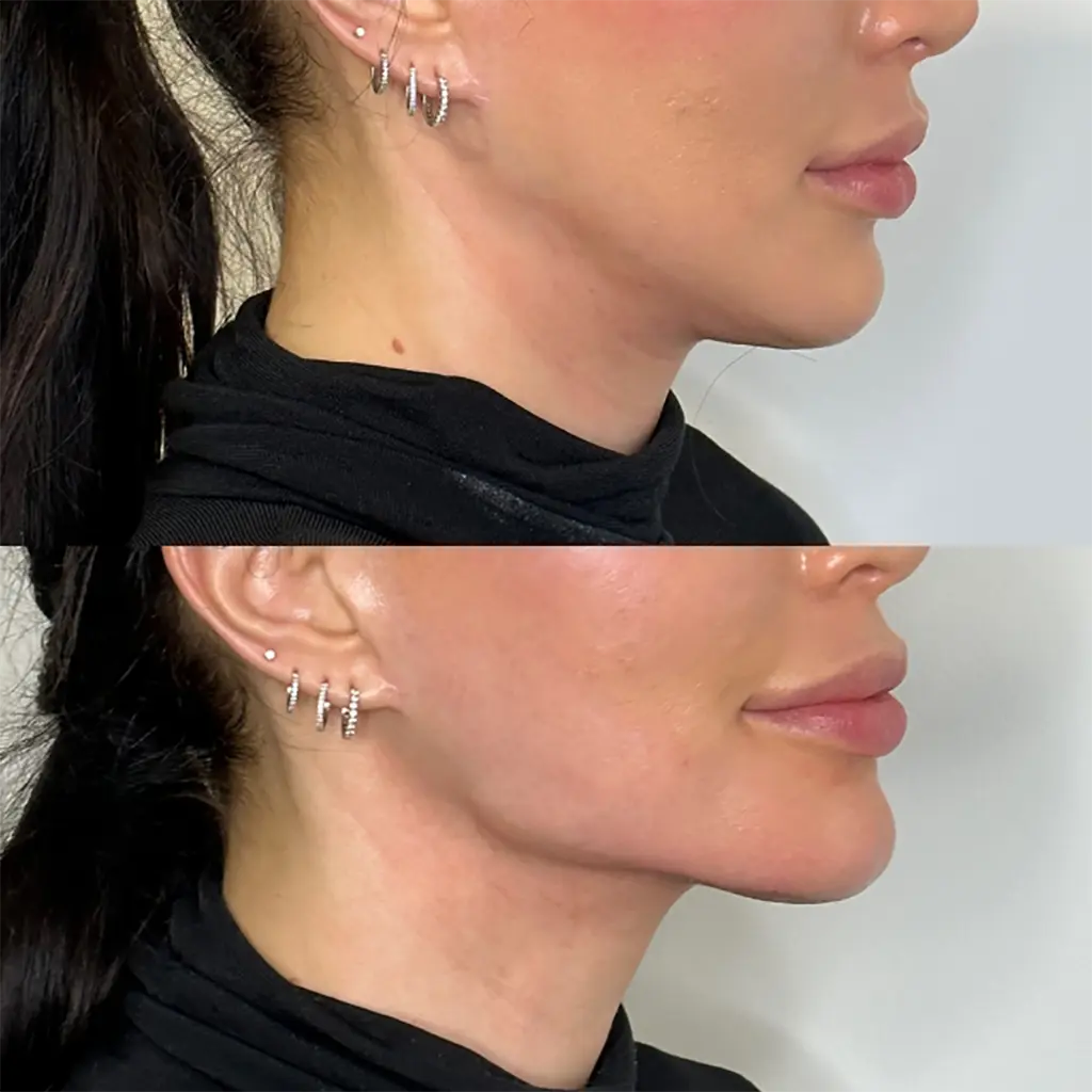 Sofwave treatment 6