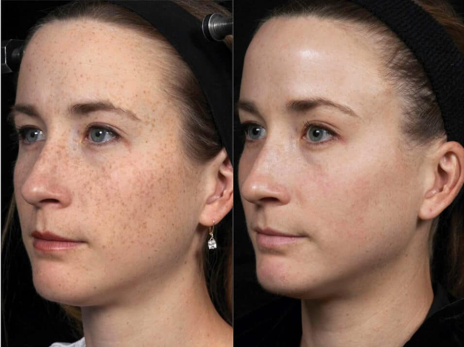 AI Skin Analysis treatment at Rani Beauty Clinic Renton