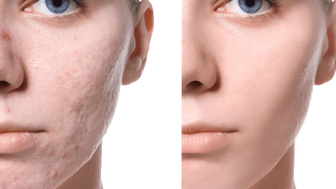 Laser Acne Facial