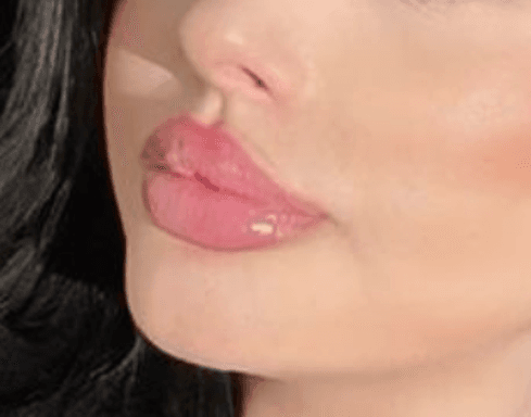 Laser Hair Removal Before & After result 9 at Rani Beauty Clinic