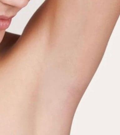 Laser Hair Removal Before & After result 5 at Rani Beauty Clinic