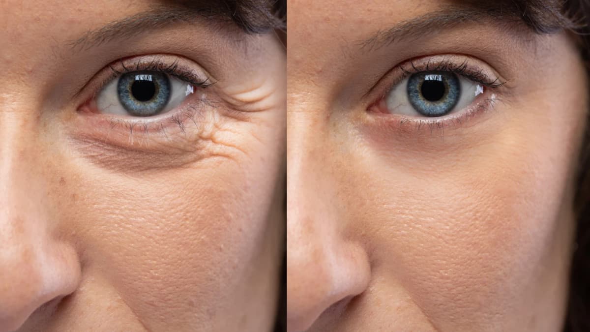 Scar Reduction Before & After result 6