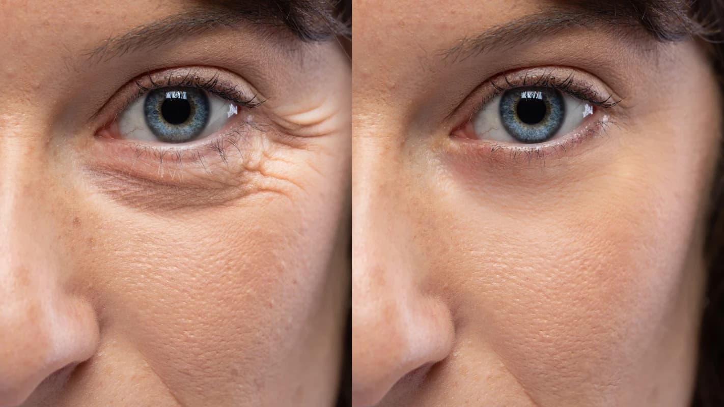 Scar Reduction Before & After result 6 at Rani Beauty Clinic