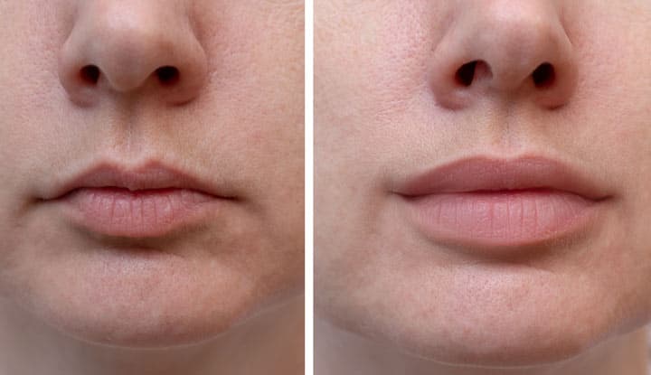 Dermal Fillers treatment at Rani Beauty Clinic Renton