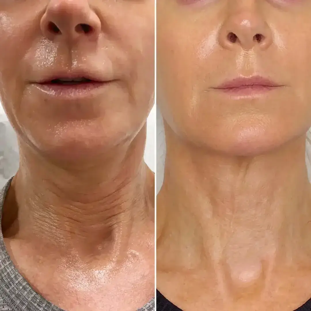 Sofwave treatment 4