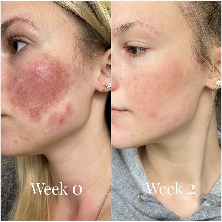 Red Light Therapy treatment at Rani Beauty Clinic Renton