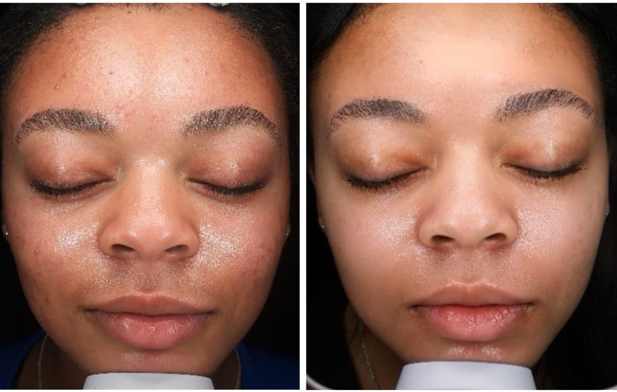 HydraFacial Before & After result 4