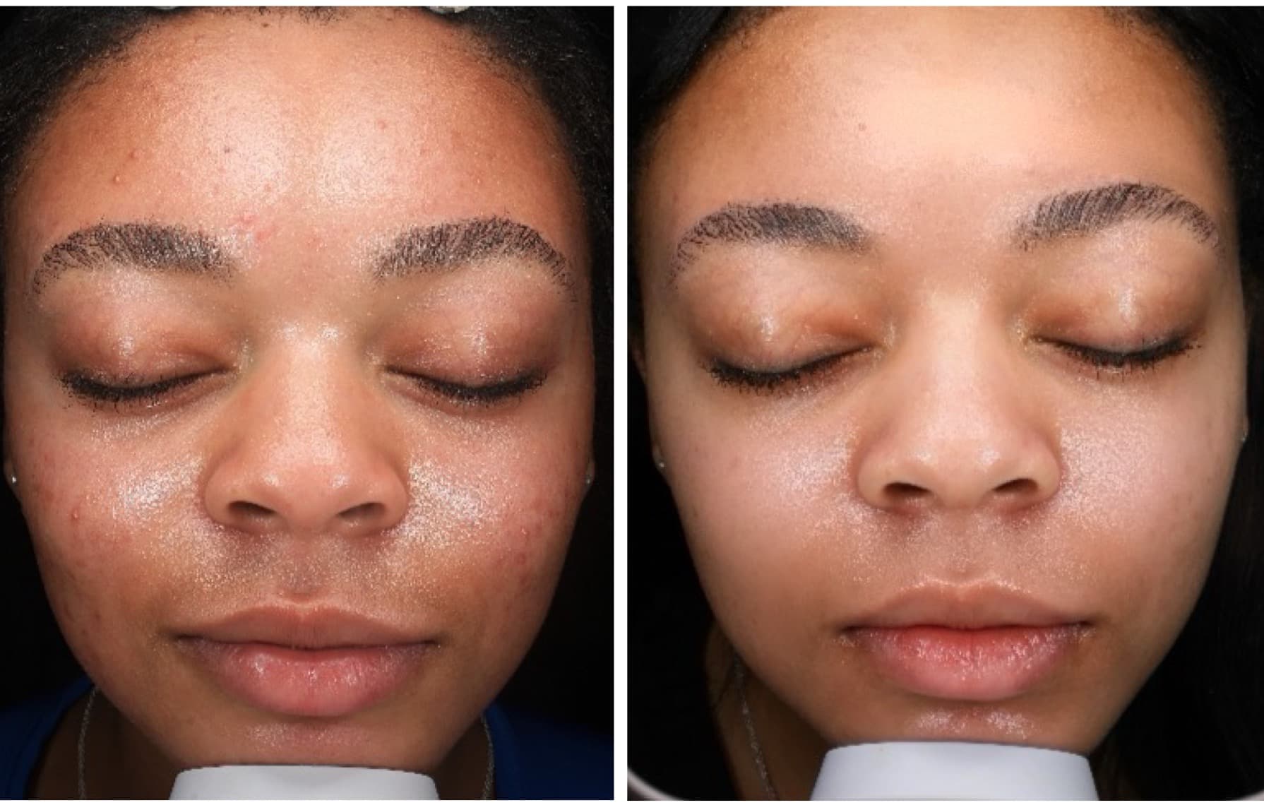 HydraFacial Before & After result 4 at Rani Beauty Clinic