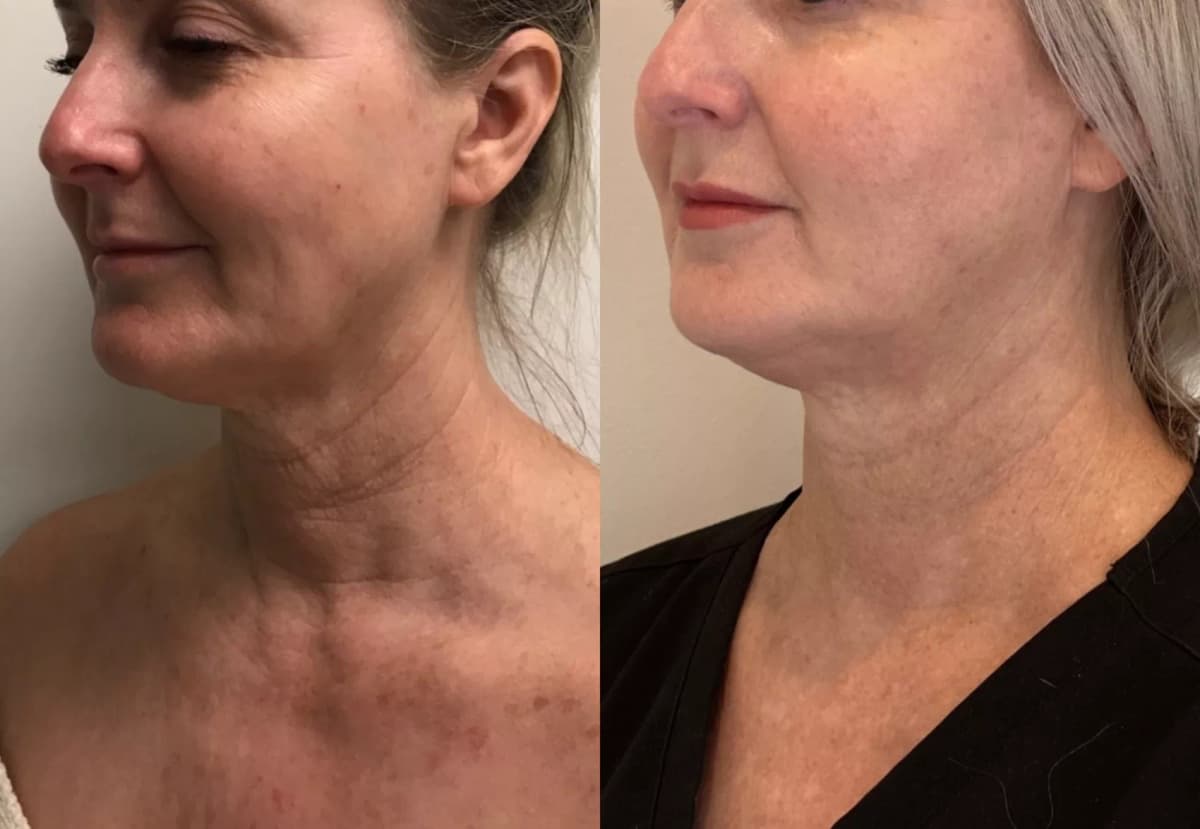 Sofwave Before & After result 2