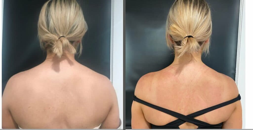 Botox & Dysport Before & After result 4 at Rani Beauty Clinic