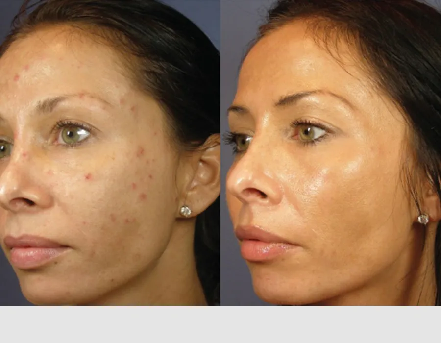 Chemical Peels Before & After result 2